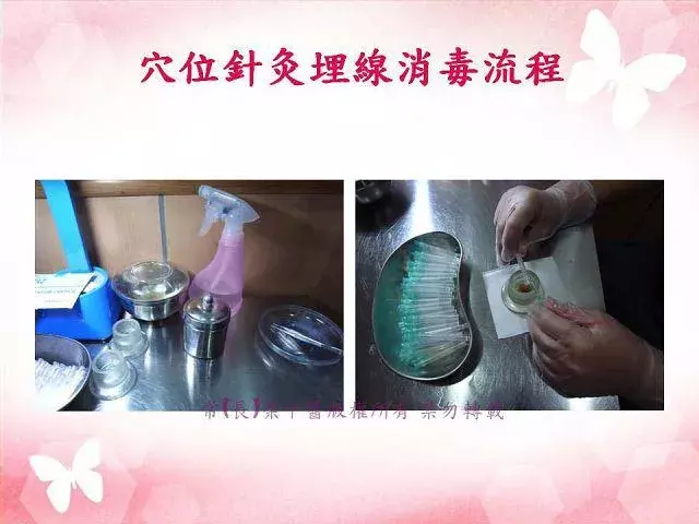 埋線減重，減肥介紹2