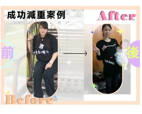 埋線減重,減肥案例2