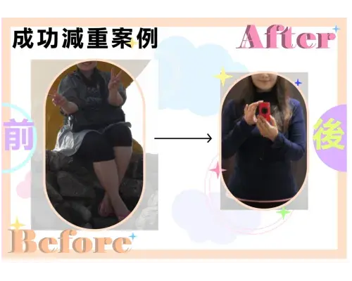 埋線減重,減肥案例3